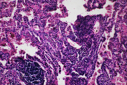 tuberculoid granuloma of hunman