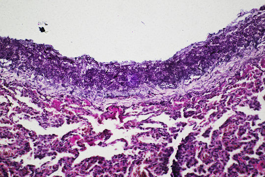 tuberculoid granuloma of hunman
