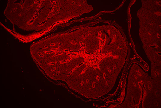 Skin papilloma of human micrograph.