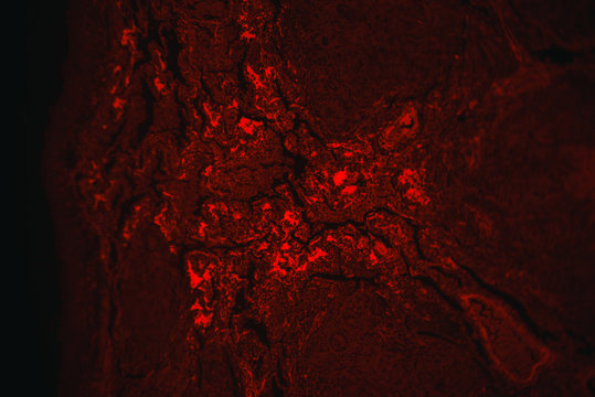 tuberculoid granuloma of hunman