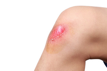 Asian boy got accident painful wound, scraped or injured on knee in football game. Close up of...