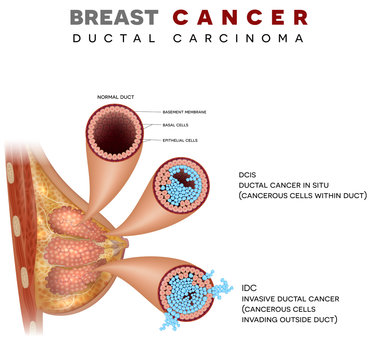 Breast cancer anatomy illustration, Ductal carcinoma