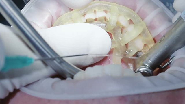 The process of implant surgery