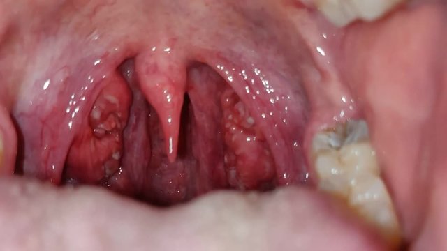 Patient with tonsil plaques