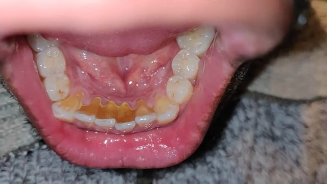 Details of teeth with tartar