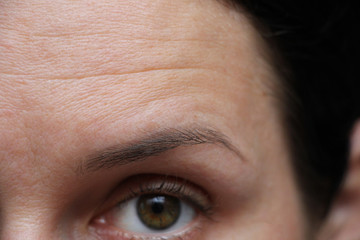 deep forehead wrinkles