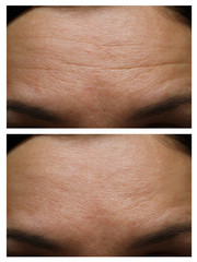 wrinkles on the forehead