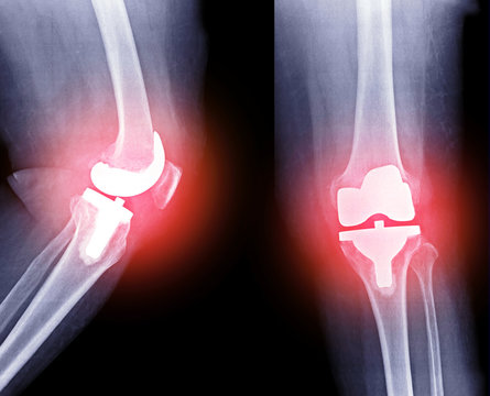 X-ray image of Right knee joint replacement (red color glow)/ knee arthroplasty AP view and Lateral view.