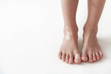  Feet on a white background. Pigmentation on the skin. White spots. Vitiligo.