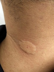 Fototapeta premium man neck after bee stings