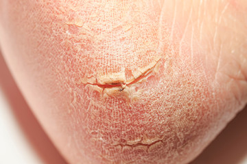 unpleasant unhealthy close-up skin cracked with deep wounds and peeling close-up on the heel