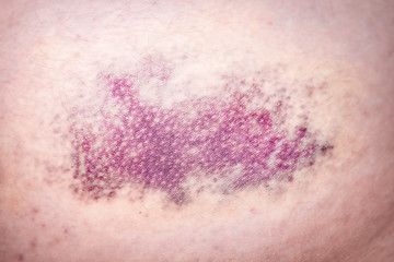 Fototapeta premium close up of bruise hit on the leg, hematoma