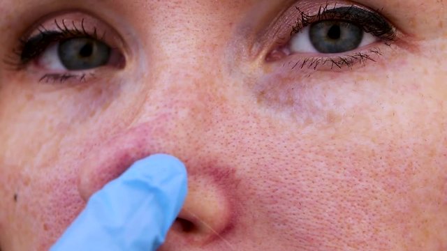Couperose on the nose of a young attractive girl. Capillary mesh treatment concept. Acne on the face. Examination by a doctor