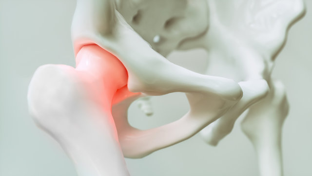 Hip pain from arthrosis - 3D Rendering