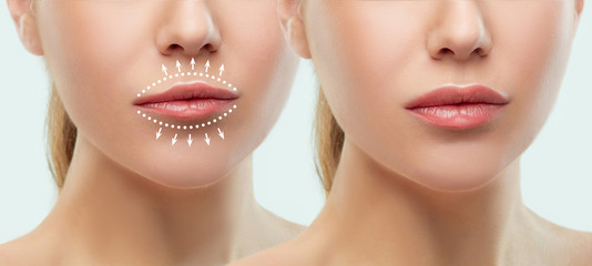 Before and after lips filler injections. Beauty plastic. Beautiful perfect lips with natural...