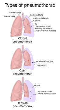 Types of Pneumothorax