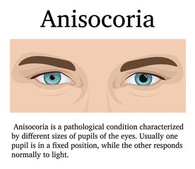 Illustration of Anisocoria