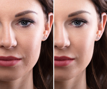 Woman's Face Before And After Cosmetic Procedure