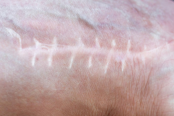 Scar with stitches on the wrist after surgery. Fracture of the bones of the hands in fist