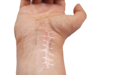 Scar with stitches on the wrist after surgery. Fracture of the bones of the hands in fist isolated...