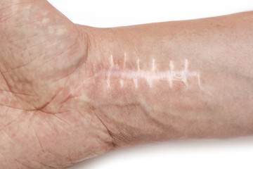 Scar with stitches on the wrist after surgery. Fracture of the bones of the hands in fist isolated on white background