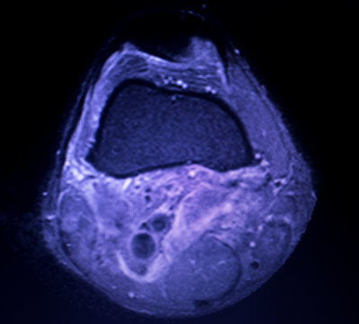 MRI knee meniscus tear scan