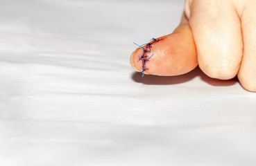 Fototapeta premium Injury. String. Cut. Medical. Treatment. Finger. Pain
