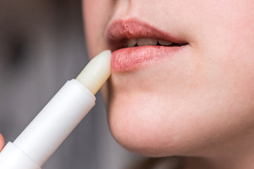 Chapped, or cracked, dry lips that have lost moisture. Woman maintains her lips. Lip Care. 