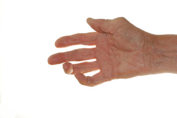 Arthritis in Man's Hand