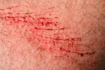 Scratch skin, wound or cut on the skin, red blood. Hairy part of a man body close-up