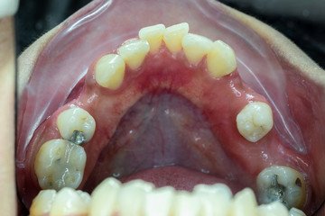 Obraz premium crowding teeth