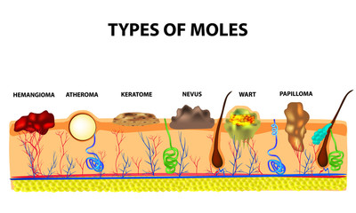 Types of moles. Nevus, pigment spot, papilloma, wart, keratoma, atheroma, hemangeoma. Mole. Anatomical structure of the skin and hair. Infographics. Vector illustration on isolated background.