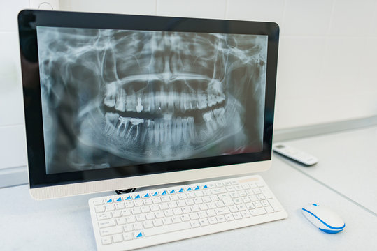 white pc desktop in white room with teeth x-ray on screen with dental prosthetics