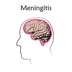 Obraz premium Meningitis. Vector medical illustration. White background, line silhouette of head, anatomy flat image of brain.