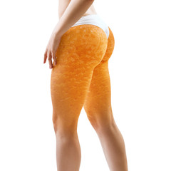 Female buttocks with orange peel texture. - obrazy, fototapety, plakaty