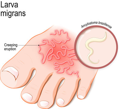Cutaneous larva migrans. Skin disease in humans.