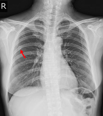 Chest x-ray Fracture right posterior 6th rib and possible fracture lateral aspect of left 9th rib.