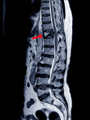 MRI Thoracic lumbar spine show moderate pathological compression fracture of T12 level.