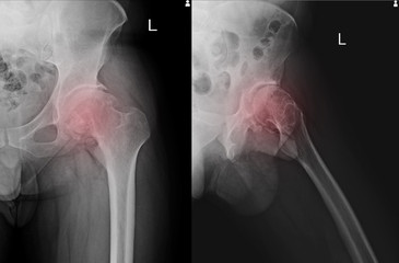 Sclerosis of articular surface of acetabular with marginal osteophytes. Osteoma at superior and...