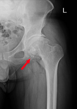 Sclerosis of articular surface of acetabular with marginal osteophytes. Osteoma at superior and inferior margins of femoral head. Calcified loose bodies in joint space.