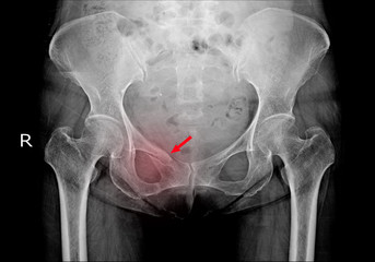 Hip x-ray Fracture right superior pubic ramus.Normal both hips.