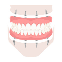 Removable denture on implants. Removable denture of the upper and lower jaw on four implants. Implant of the upper and lower jaw. Full arch prosthesis on dental implants. Vector illustration