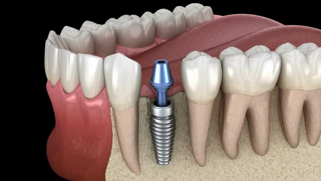 Premolar tooth recovery with implant. Medically accurate 3D animation of human teeth and dentures concept