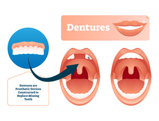 Dentures vector illustration. Medical prosthetic device for missing teeth.
