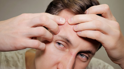 Fototapeta premium young man squeezing a pimple. Acne treatment.