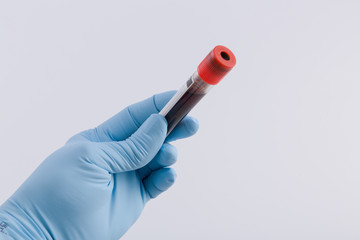 Medizinerhand mit Handschuh hält eine Blutprobe