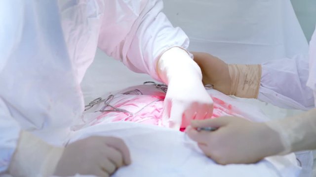 Close-up hands of professional medical staff performing operation on abdominal cavity