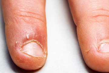 Close up of hand with bitten finger and fingernails.