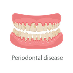 Dental concept, gum treatment. Gum disease and teeth, periodontal disease. Gum disease, bleeding gums, unhealthy teeth, yellow teeth, bad teeth. Vector illustration.