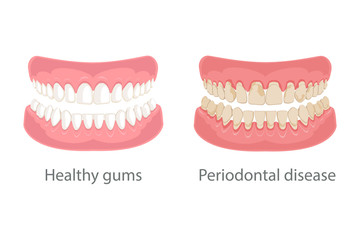 Dental concept, gum treatment. Gum disease and teeth, periodontal disease. Gum disease, bleeding gums, unhealthy teeth, yellow teeth, bad teeth. Vector illustration.